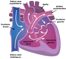 Schéma d’un cœur présentant une atrésie tricuspide.