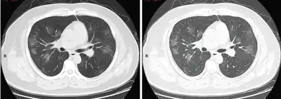 Stade 2 (progressif)