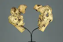 Fractures par coup de feu en dessous des deux trochanters