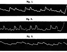 Pouls paradoxal de Kussmaul
