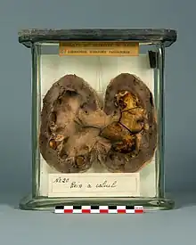 Lithiase rénale avec dilatation du bassinet et des calices