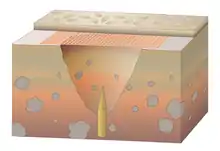 Trou de loup, dispositif piège simple : trou dissimulé comportant un ou plusieurs pieux au fond