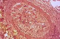 Hyphes dans un vaisseau sanguin (vue en coupe).